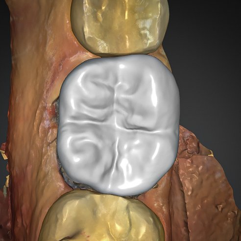 Escaneamento Intraoral